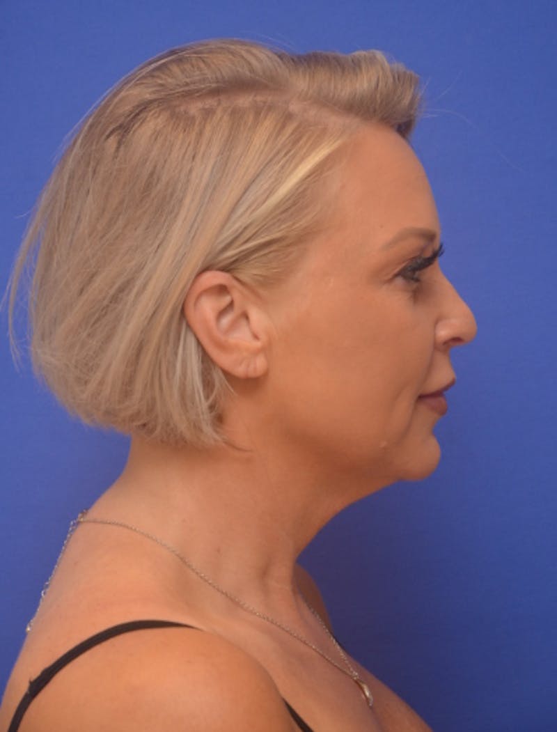 Neck Liposuction Before & After Gallery - Patient 214085 - Image 7