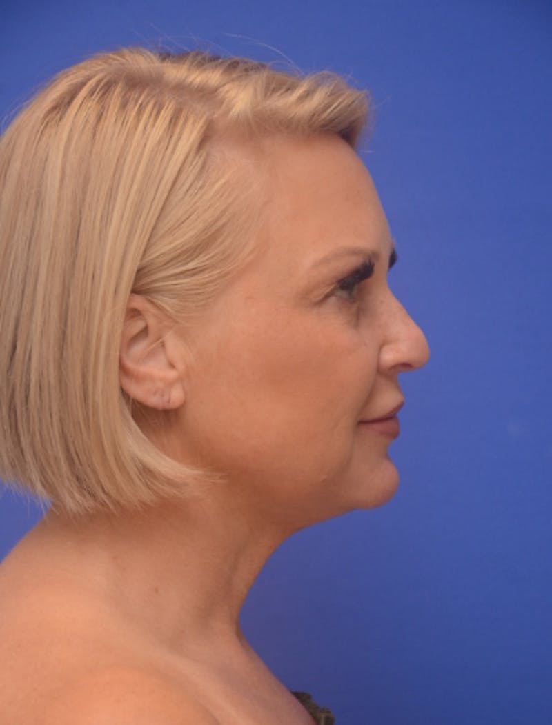 Neck Liposuction Before & After Gallery - Patient 214085 - Image 8