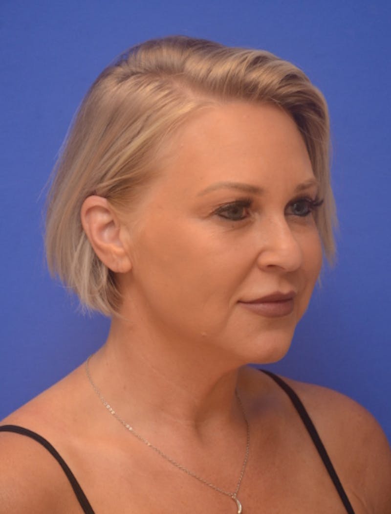 Neck Liposuction Before & After Gallery - Patient 214085 - Image 9