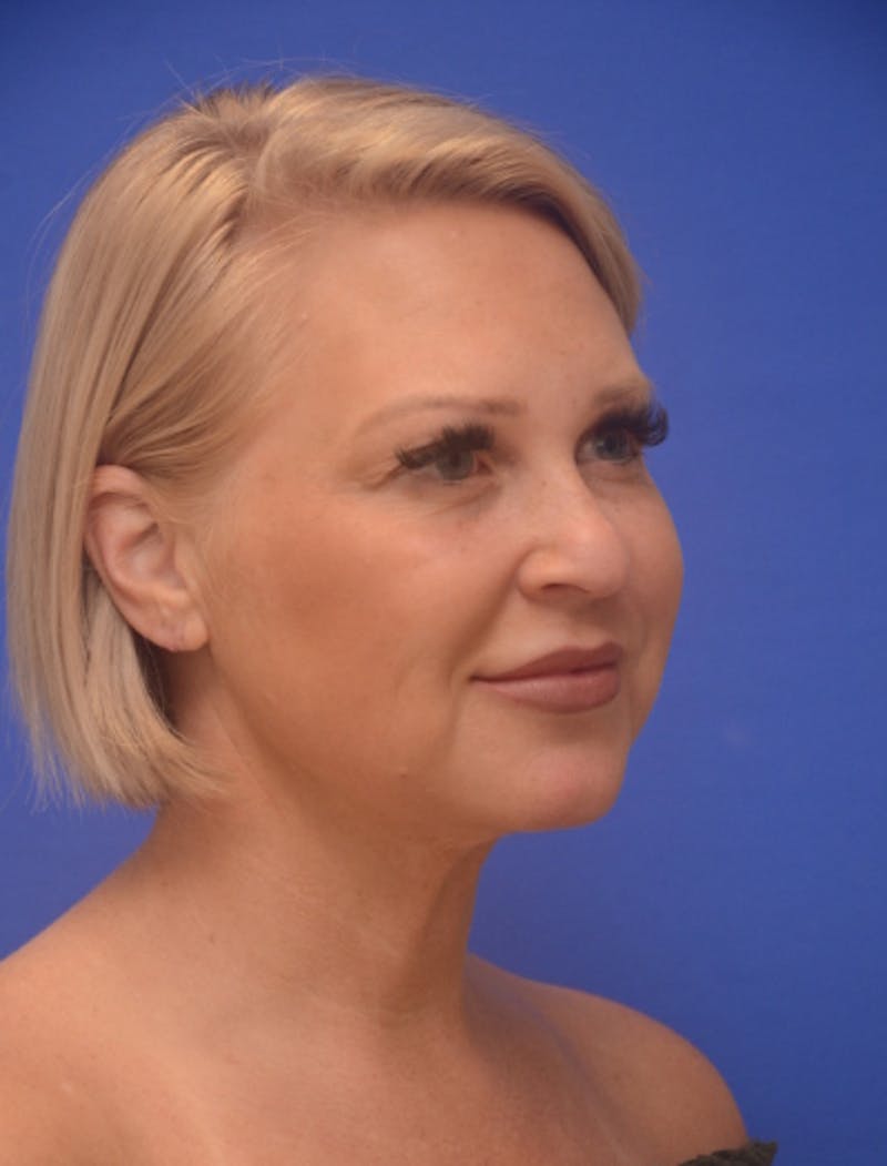 Neck Liposuction Before & After Gallery - Patient 214085 - Image 10