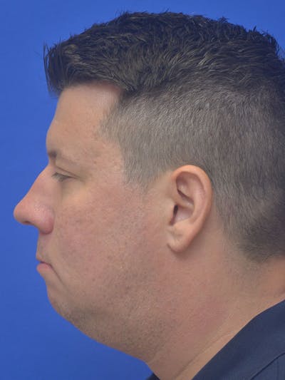 Neck Liposuction Before & After Gallery - Patient 395029 - Image 1