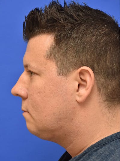 Neck Liposuction Before & After Gallery - Patient 395029 - Image 2