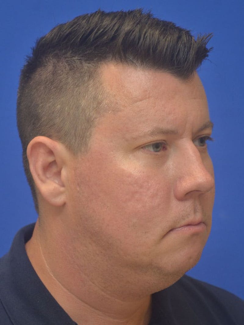 Neck Liposuction Before & After Gallery - Patient 395029 - Image 5