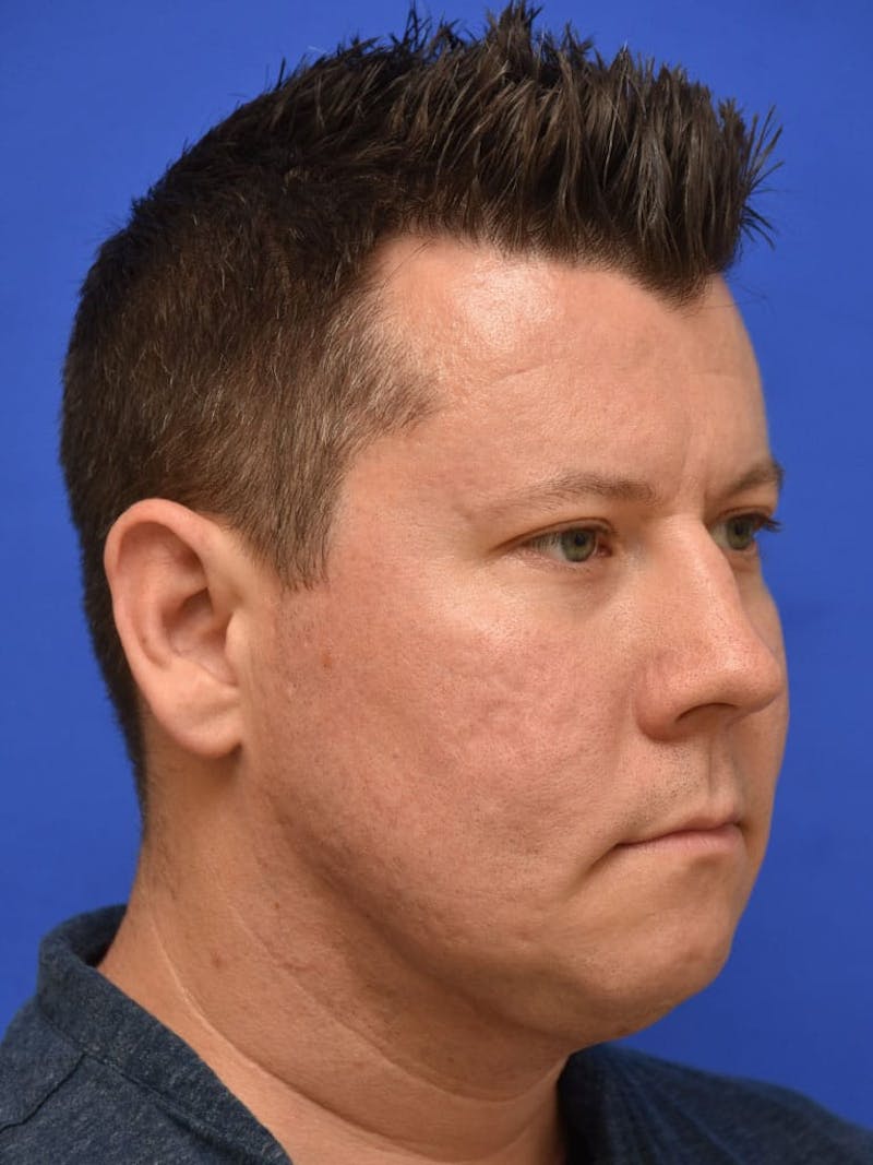 Neck Liposuction Before & After Gallery - Patient 395029 - Image 6