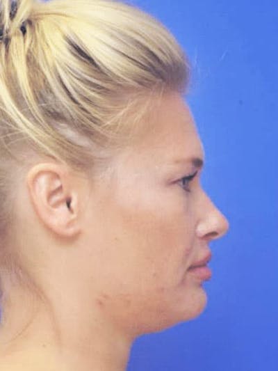 Neck Liposuction Before & After Gallery - Patient 407210 - Image 1