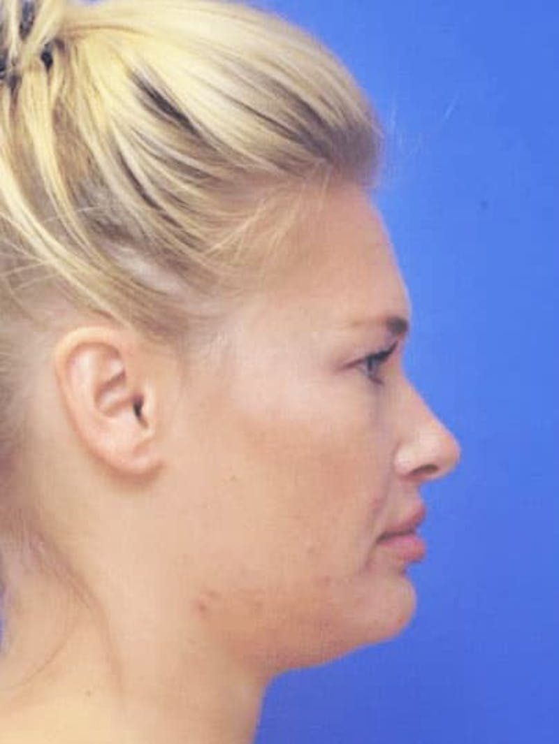 Neck Liposuction Before & After Gallery - Patient 407210 - Image 1