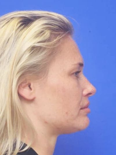Neck Liposuction Before & After Gallery - Patient 407210 - Image 2