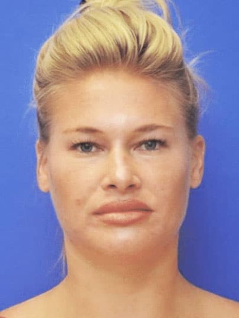 Neck Liposuction Before & After Gallery - Patient 407210 - Image 3