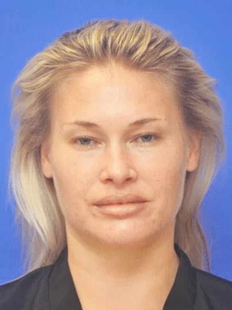 Neck Liposuction Before & After Gallery - Patient 407210 - Image 4