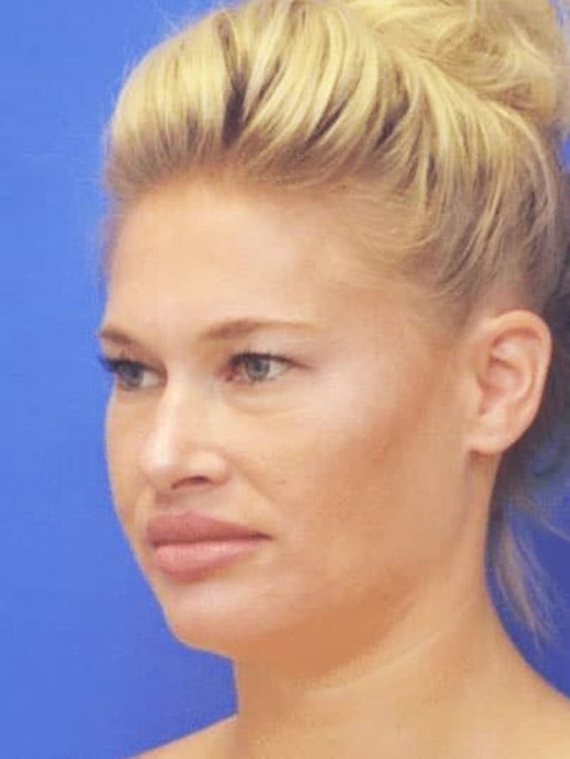 Neck Liposuction Before & After Gallery - Patient 407210 - Image 5