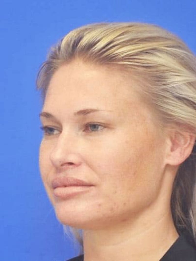 Neck Liposuction Before & After Gallery - Patient 407210 - Image 6