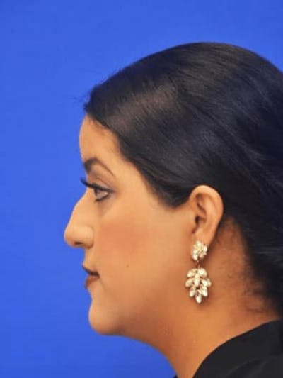 Neck Liposuction Before & After Gallery - Patient 248101 - Image 1