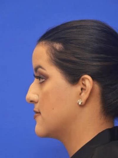 Neck Liposuction Before & After Gallery - Patient 248101 - Image 2