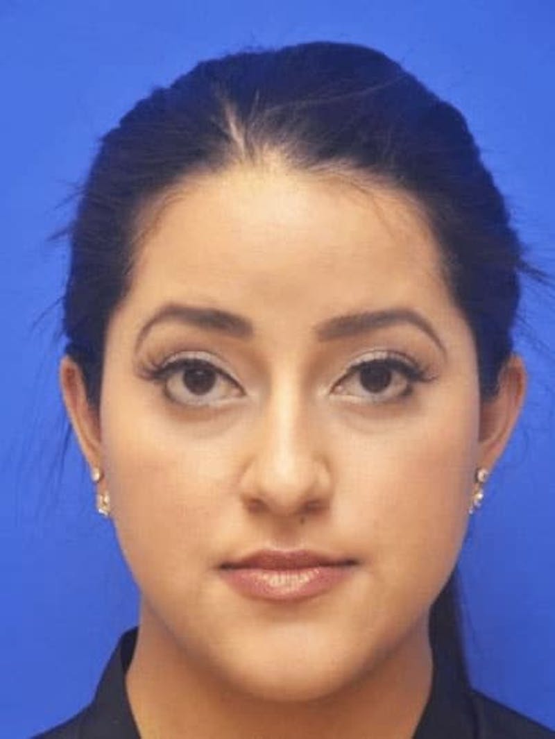 Neck Liposuction Before & After Gallery - Patient 248101 - Image 3