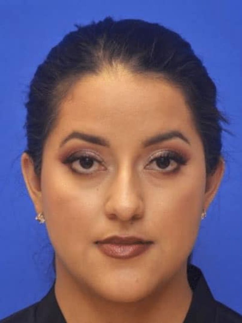 Neck Liposuction Before & After Gallery - Patient 248101 - Image 4