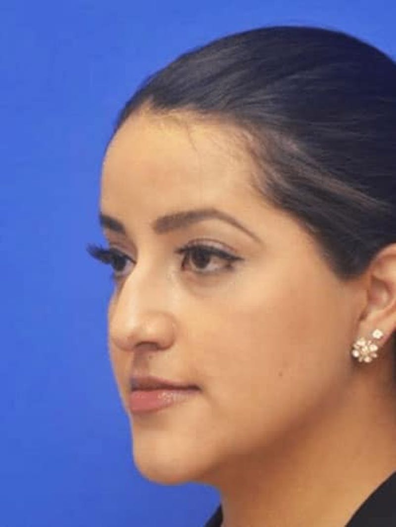 Neck Liposuction Before & After Gallery - Patient 248101 - Image 5