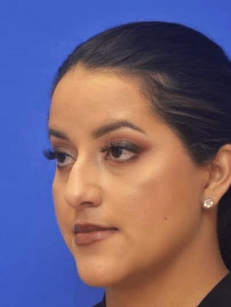 Neck Liposuction Before & After Gallery - Patient 248101 - Image 6
