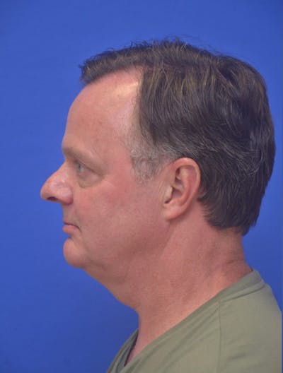 Neck Liposuction Before & After Gallery - Patient 262977 - Image 1
