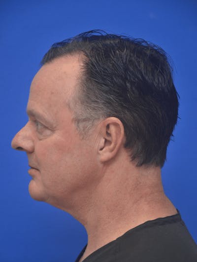 Neck Liposuction Before & After Gallery - Patient 262977 - Image 2