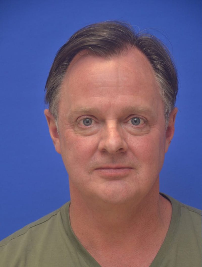 Neck Liposuction Before & After Gallery - Patient 262977 - Image 3