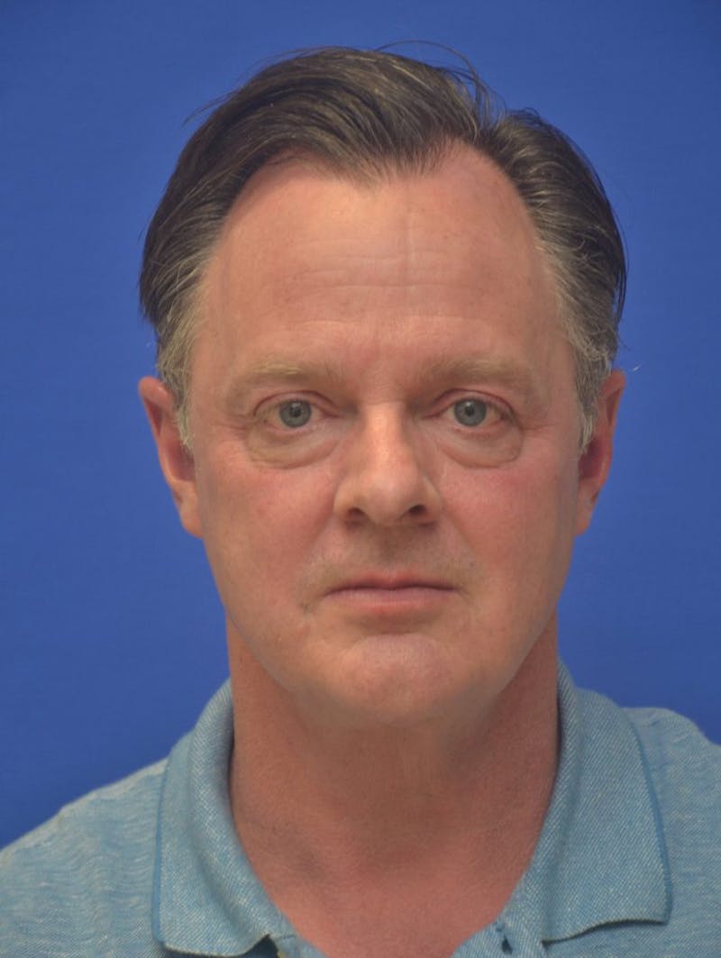 Neck Liposuction Before & After Gallery - Patient 262977 - Image 4