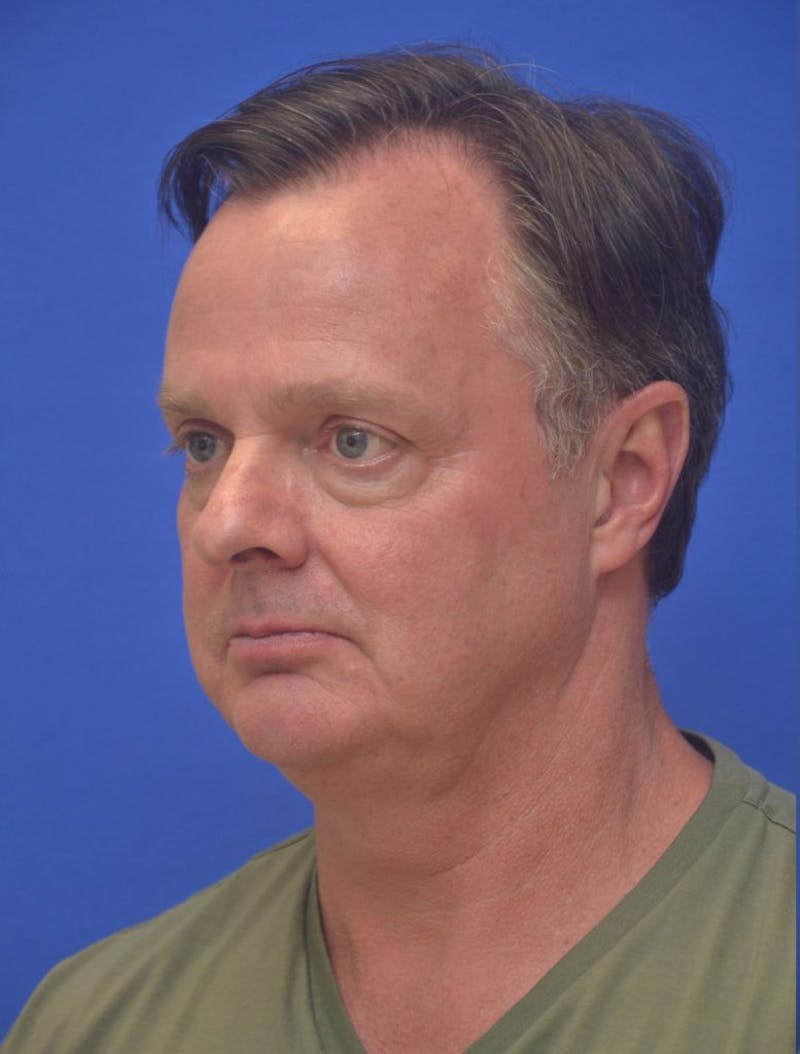 Neck Liposuction Before & After Gallery - Patient 262977 - Image 5