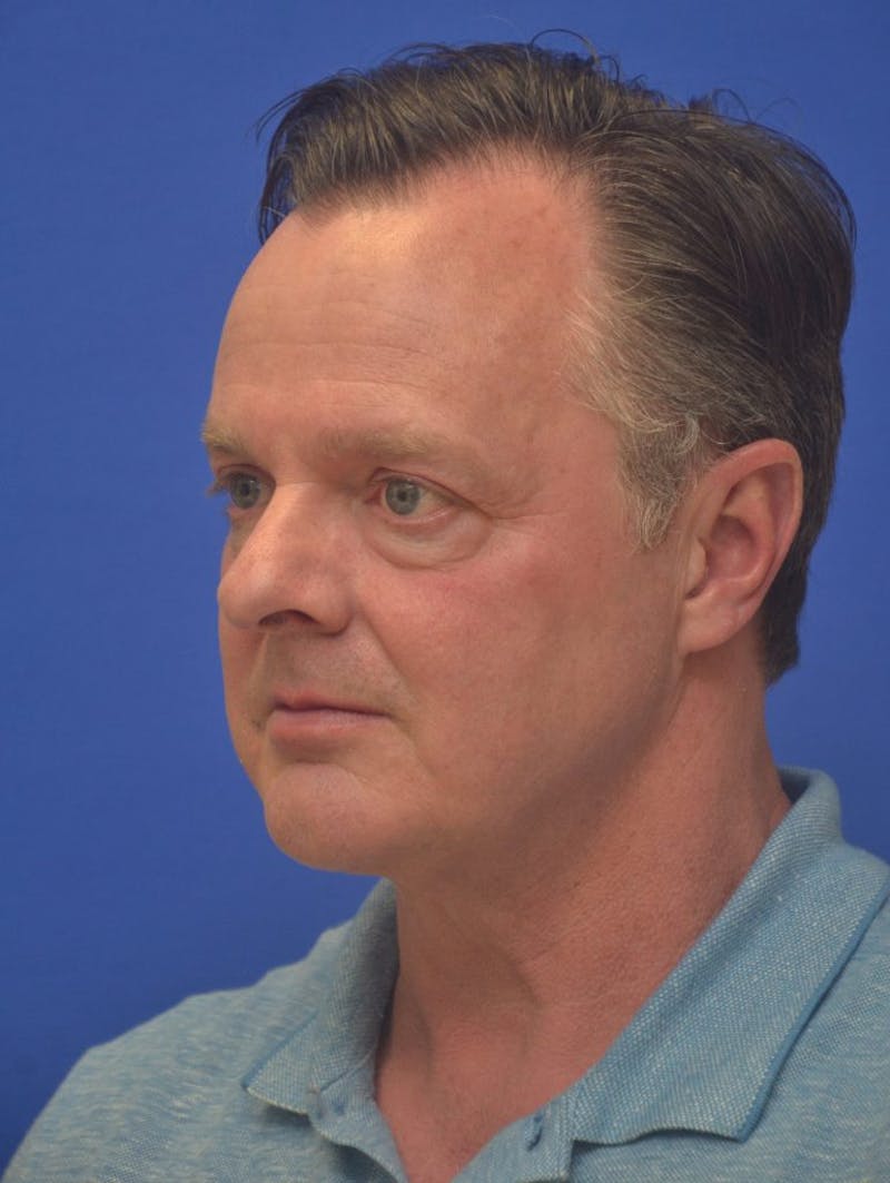 Neck Liposuction Before & After Gallery - Patient 262977 - Image 6