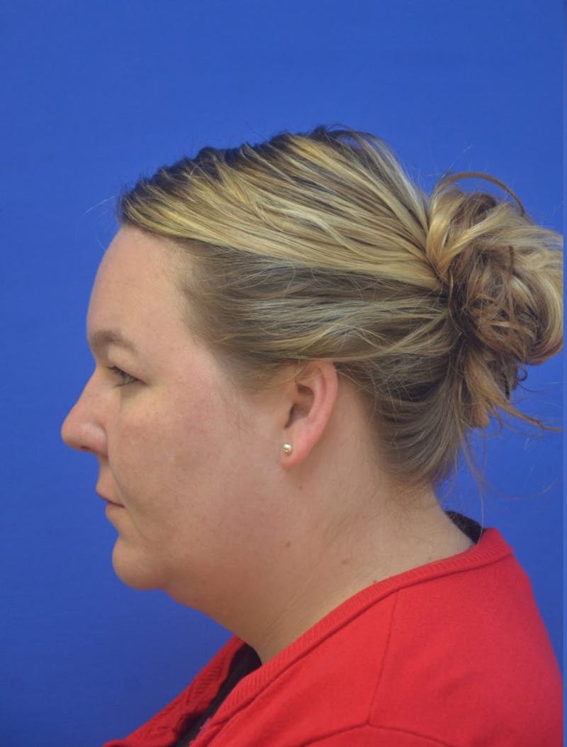 Neck Liposuction Before & After Gallery - Patient 190923 - Image 1