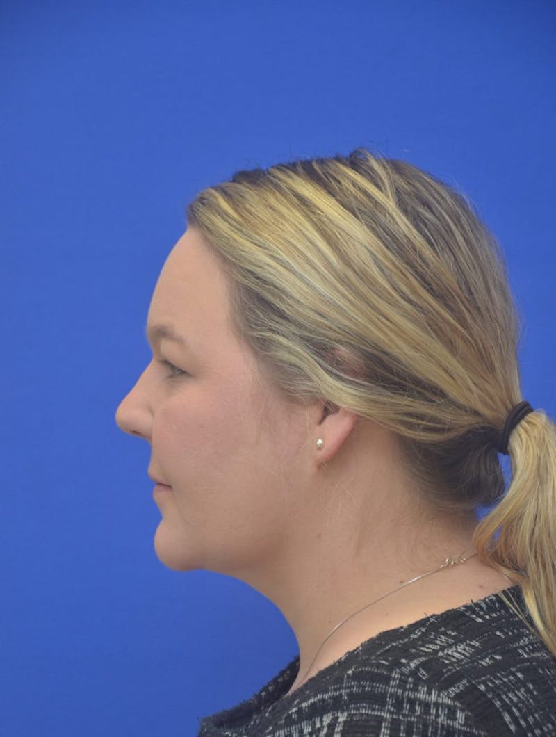 Neck Liposuction Before & After Gallery - Patient 190923 - Image 2