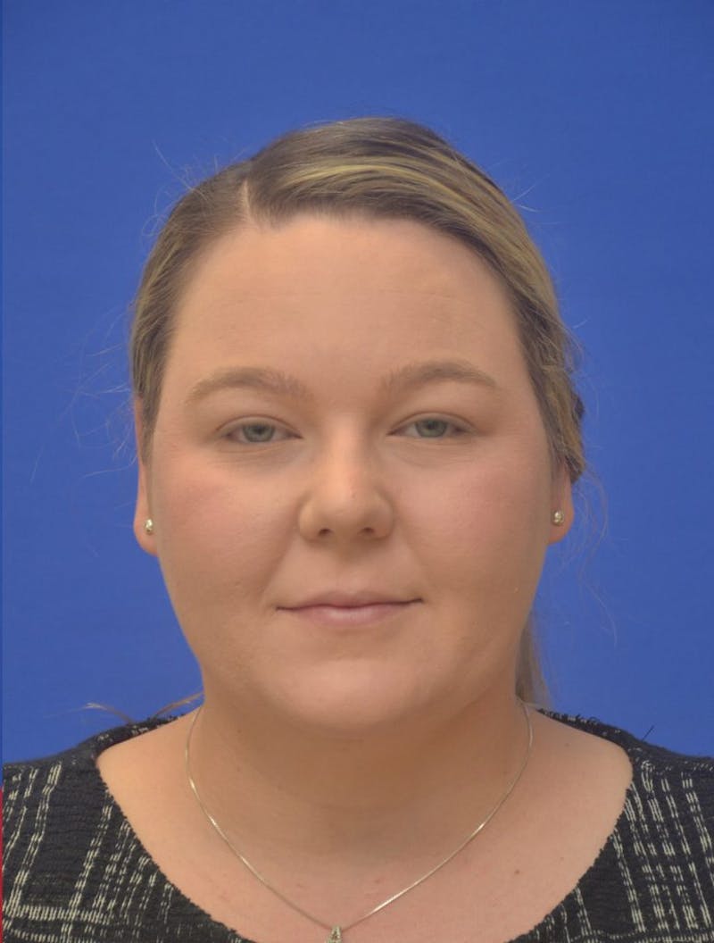 Neck Liposuction Before & After Gallery - Patient 190923 - Image 4