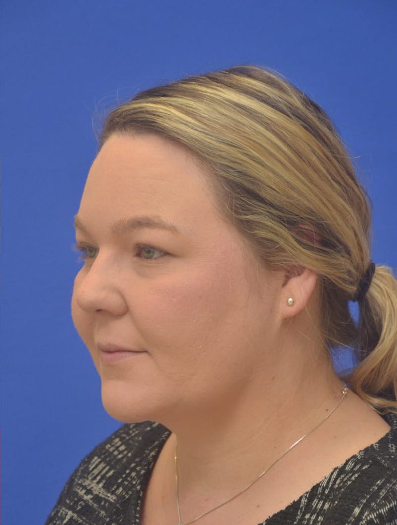 Neck Liposuction Before & After Gallery - Patient 190923 - Image 6