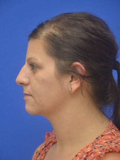 Neck Liposuction Before & After Gallery - Patient 161180 - Image 1
