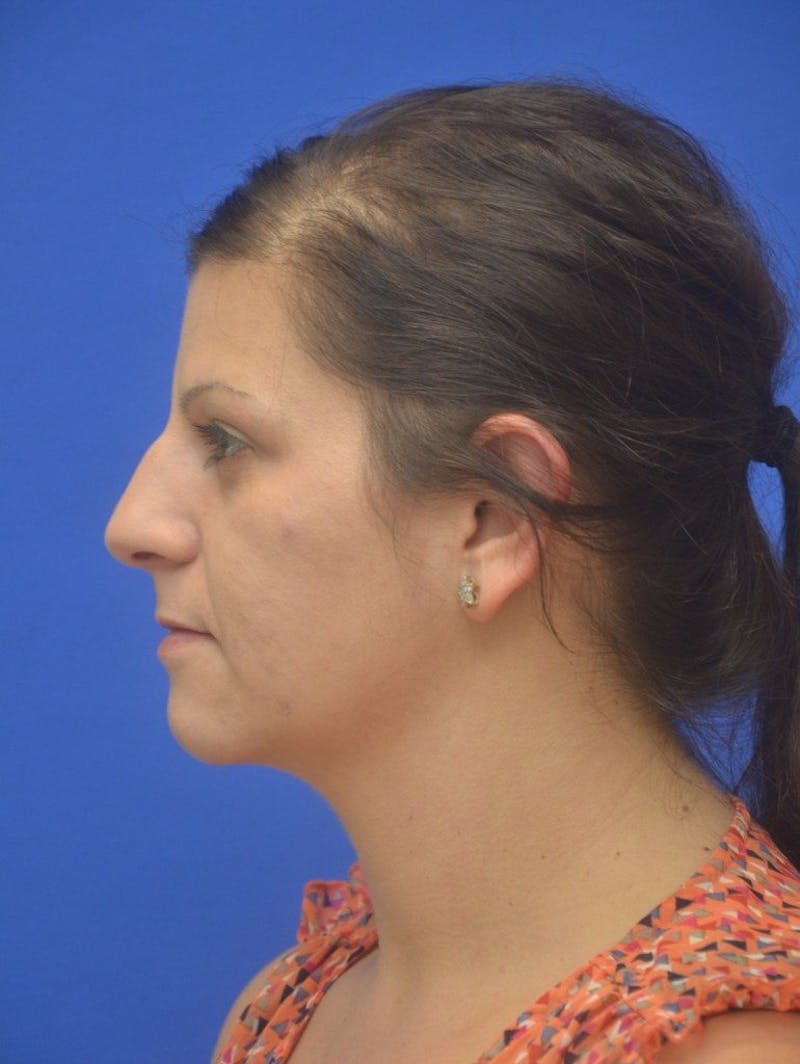 Neck Liposuction Before & After Gallery - Patient 161180 - Image 1