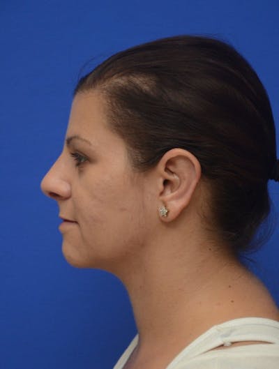 Neck Liposuction Before & After Gallery - Patient 161180 - Image 2