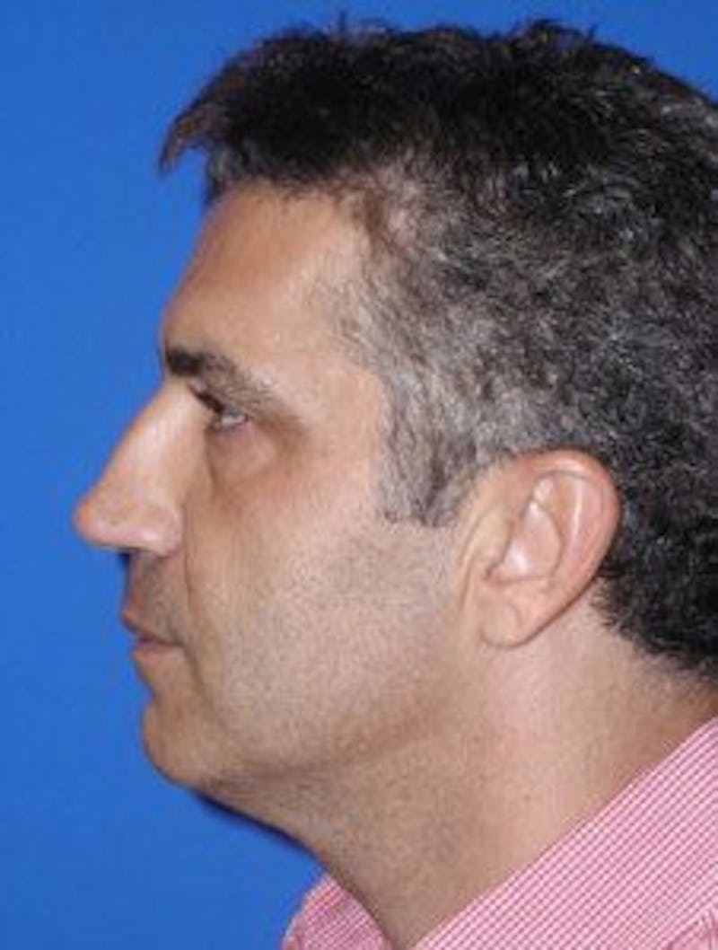 Neck Liposuction Before & After Gallery - Patient 295735 - Image 1