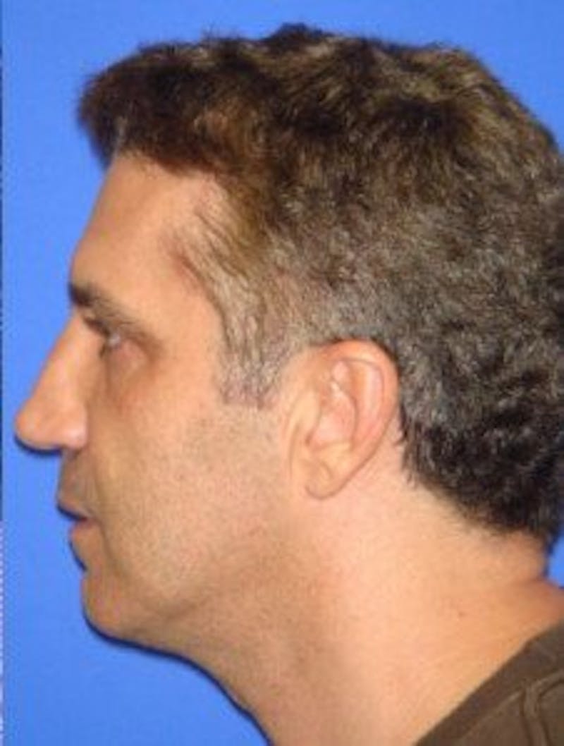 Neck Liposuction Before & After Gallery - Patient 295735 - Image 2