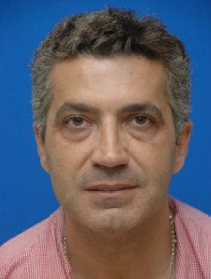 Neck Liposuction Before & After Gallery - Patient 295735 - Image 3