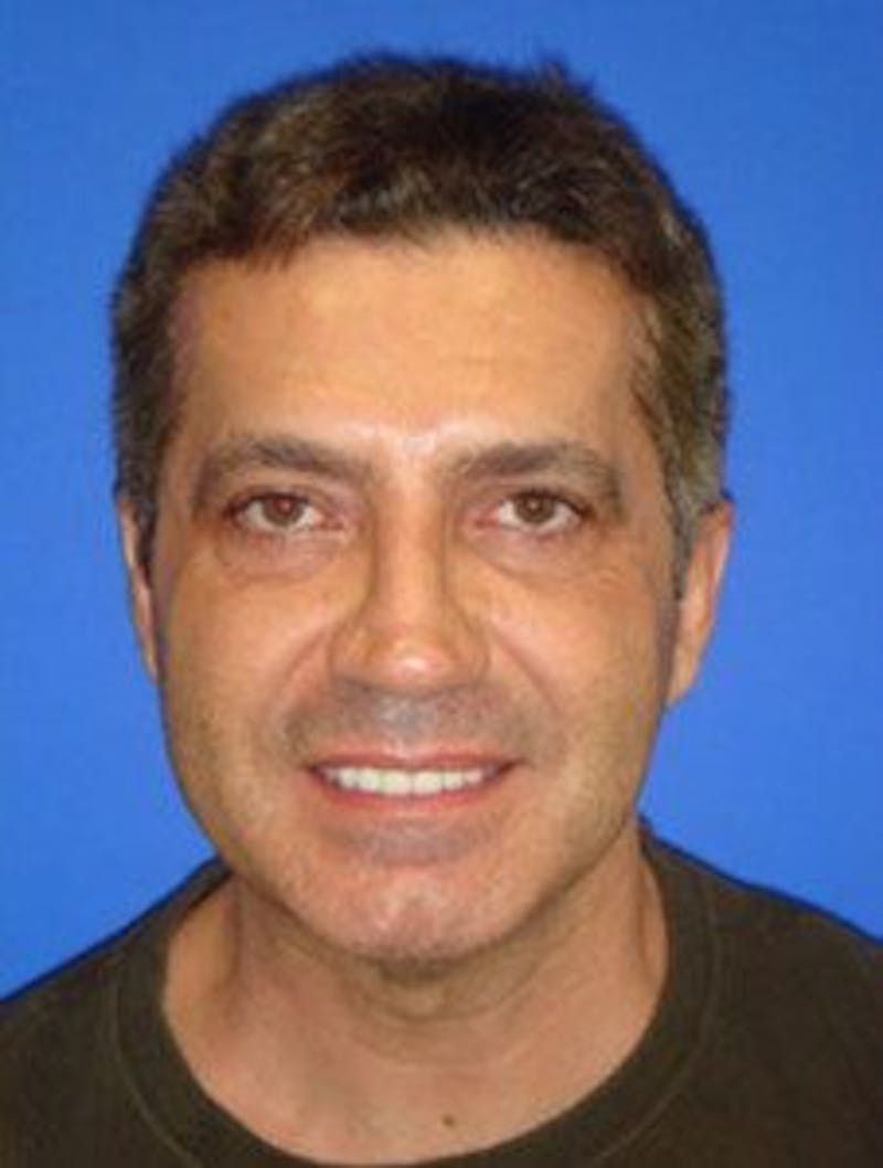Neck Liposuction Before & After Gallery - Patient 295735 - Image 4