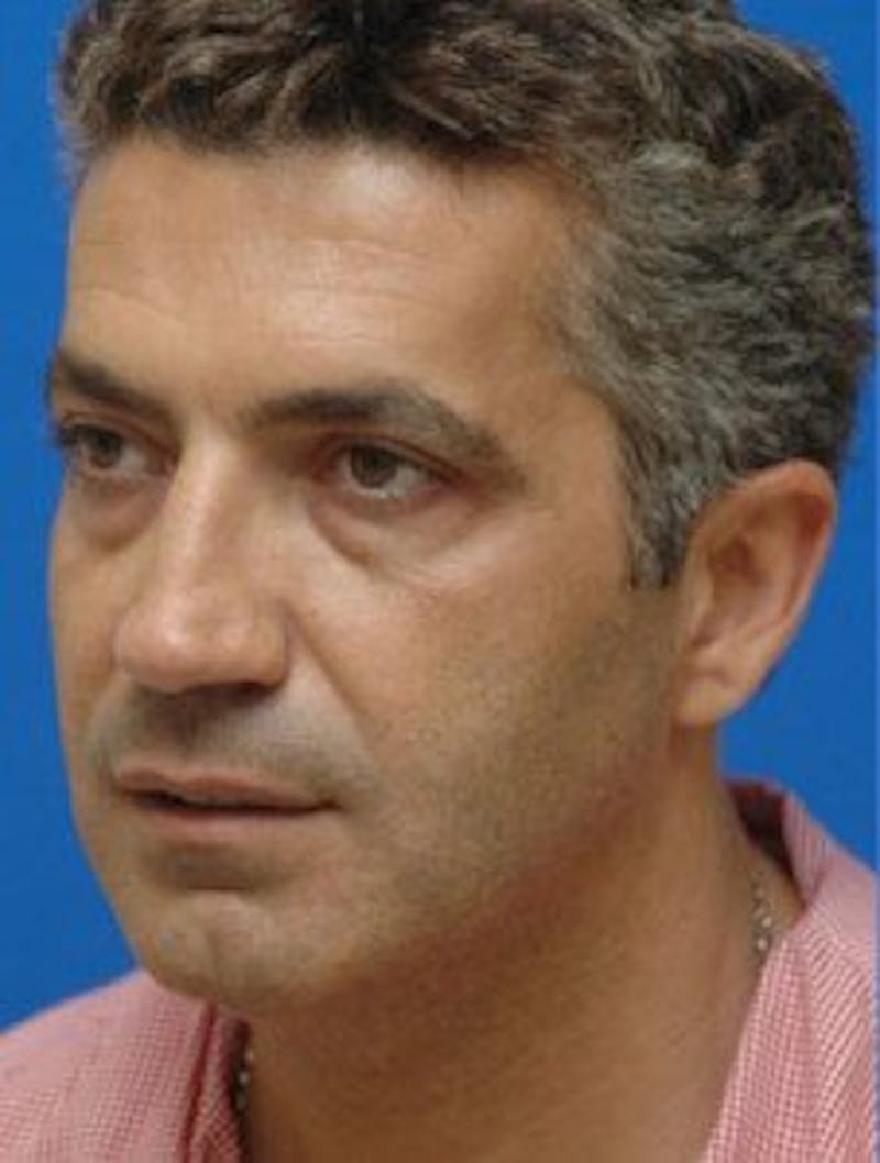 Neck Liposuction Before & After Gallery - Patient 295735 - Image 5
