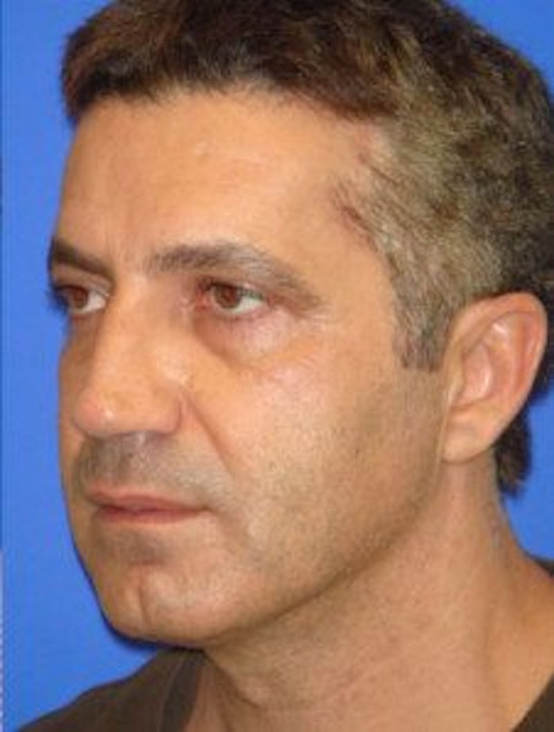 Neck Liposuction Before & After Gallery - Patient 295735 - Image 6