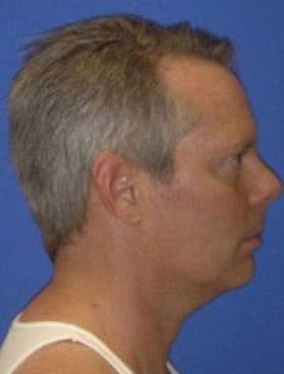 Neck Liposuction Before & After Gallery - Patient 227610 - Image 1