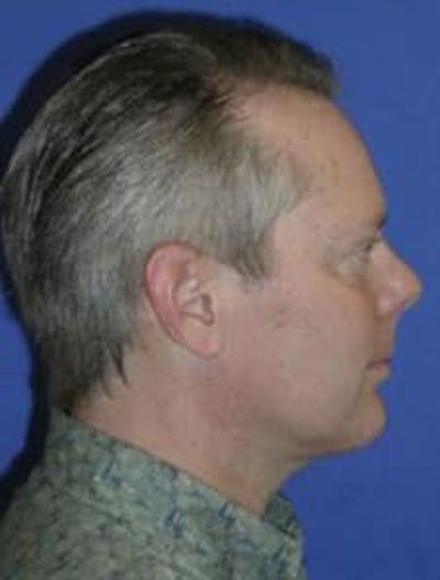 Neck Liposuction Before & After Gallery - Patient 227610 - Image 2