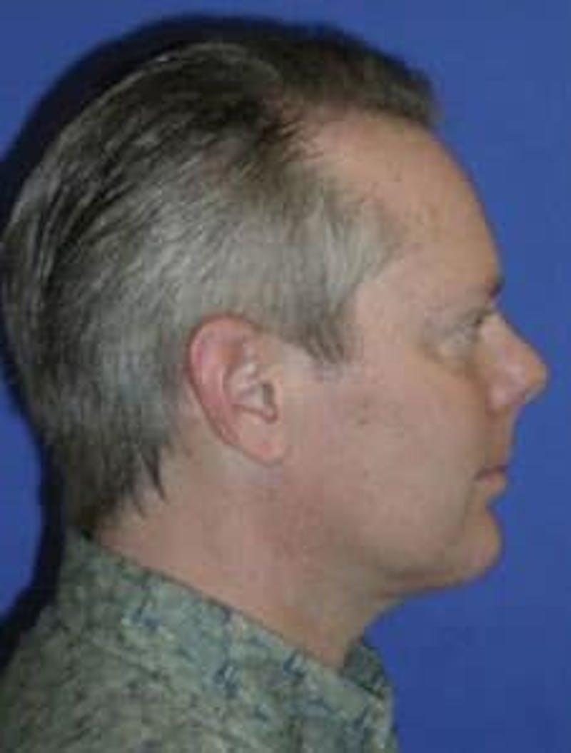 Neck Liposuction Before & After Gallery - Patient 227610 - Image 2