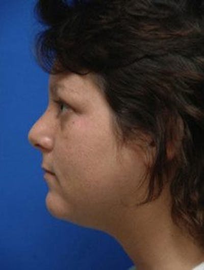 Neck Liposuction Before & After Gallery - Patient 361907 - Image 1