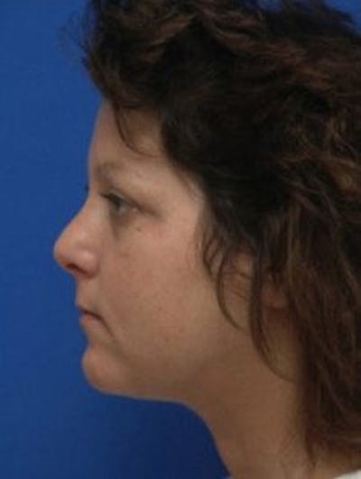Neck Liposuction Before & After Gallery - Patient 361907 - Image 2