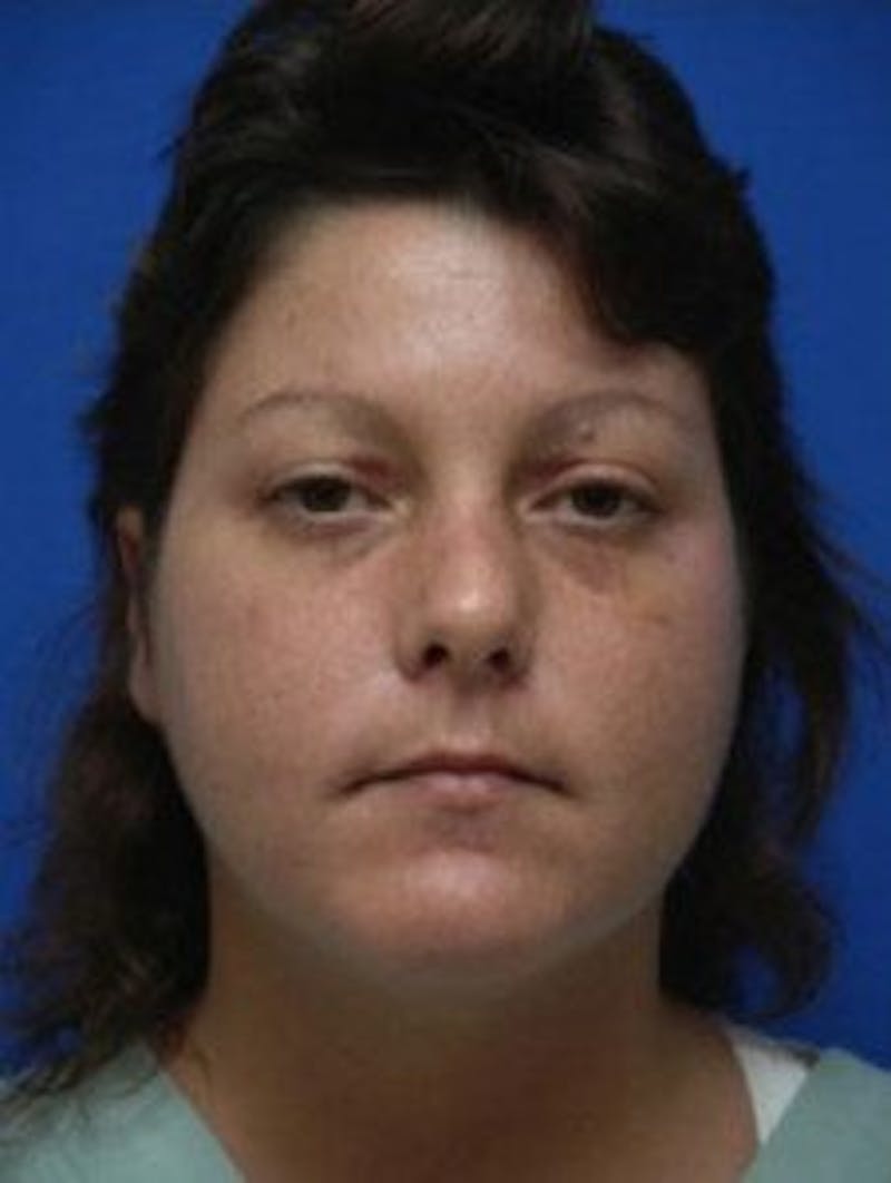 Neck Liposuction Before & After Gallery - Patient 361907 - Image 3