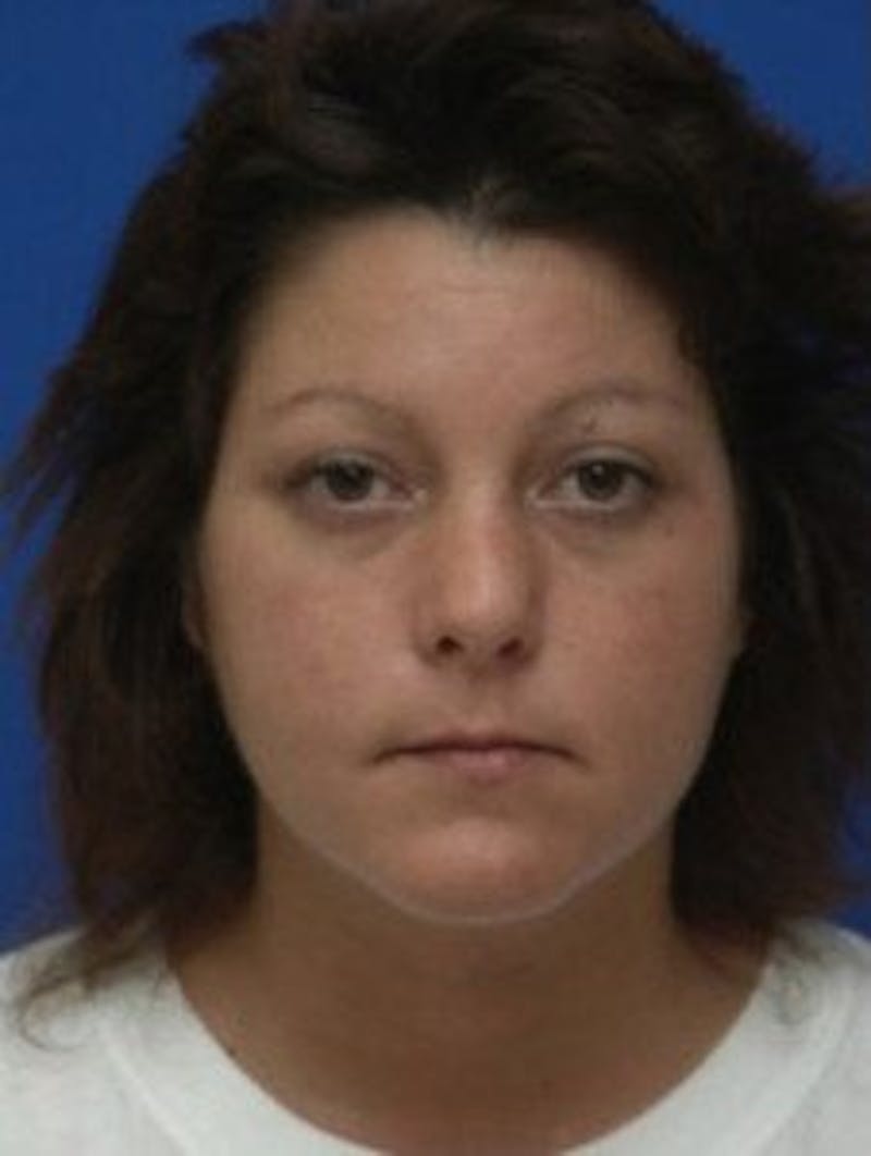Neck Liposuction Before & After Gallery - Patient 361907 - Image 4