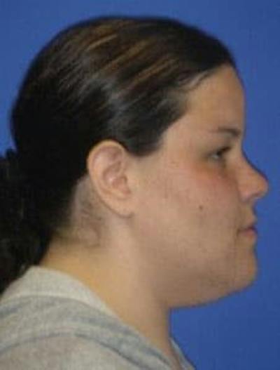 Neck Liposuction Before & After Gallery - Patient 547257 - Image 1