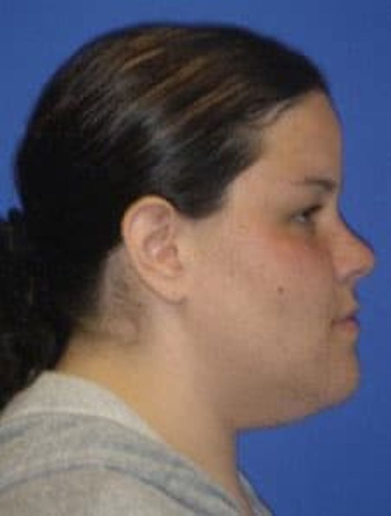 Neck Liposuction Before & After Gallery - Patient 547257 - Image 1