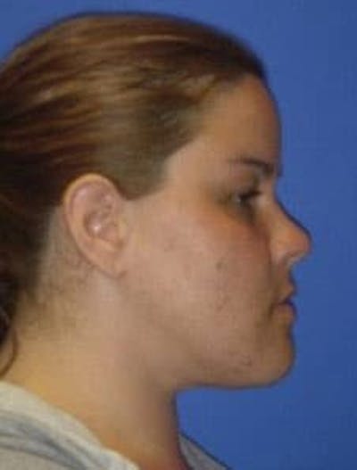 Neck Liposuction Before & After Gallery - Patient 547257 - Image 2